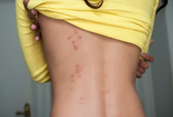bed bug bites a man back it looks wired